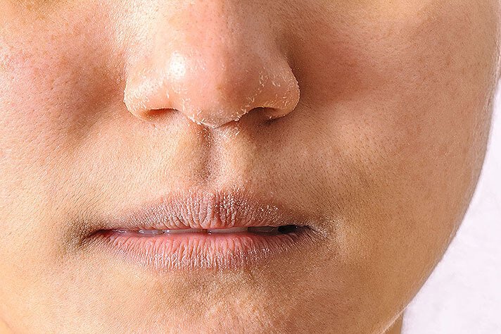 Close-up of a person's lips and nose with dry skin and visible flakes.