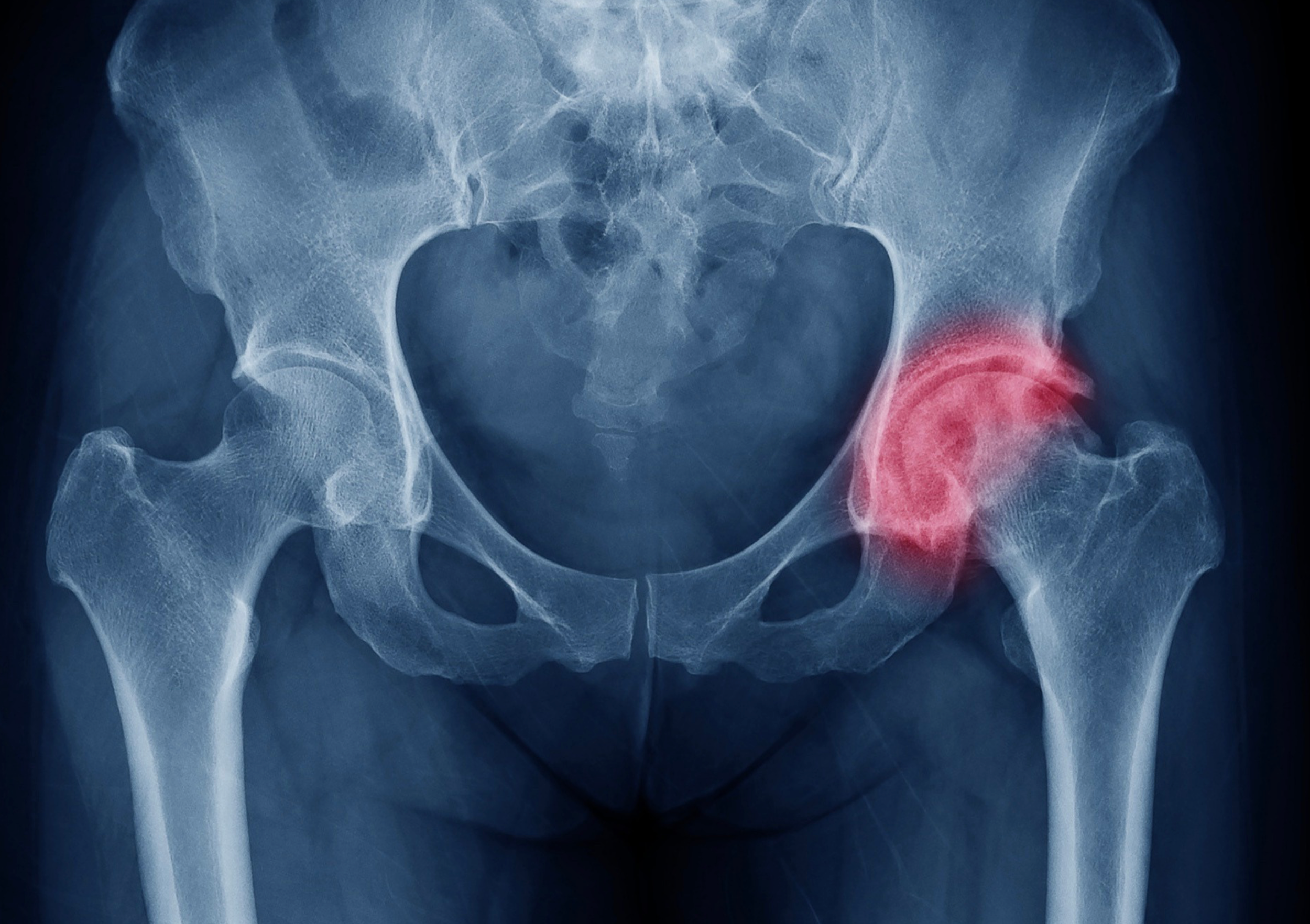 X-ray image of a pelvis highlighting a red area near the right hip.