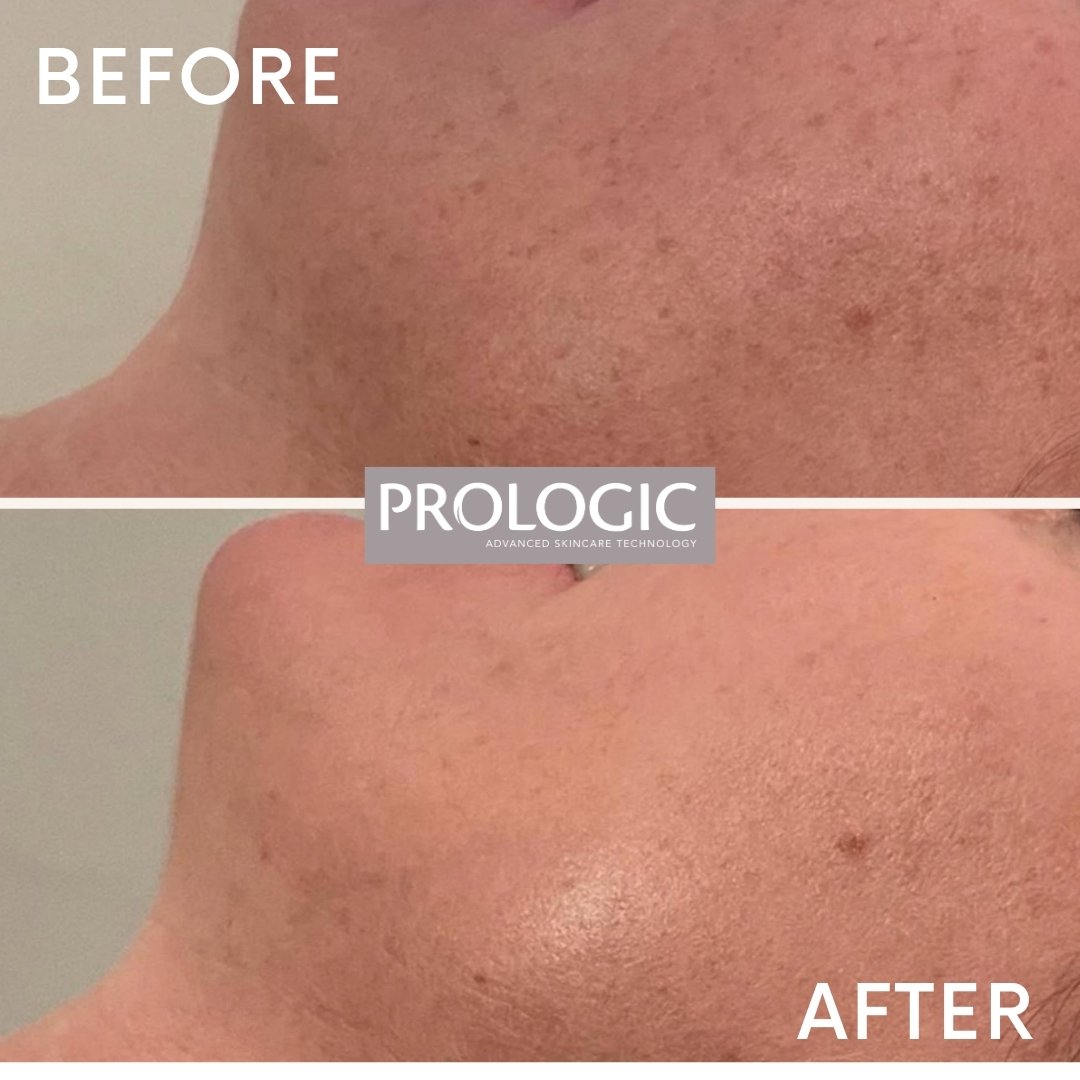 Close-up of a person's cheek showing before and after result of skincare treatment with smoother skin and reduced blemishes in the after image.