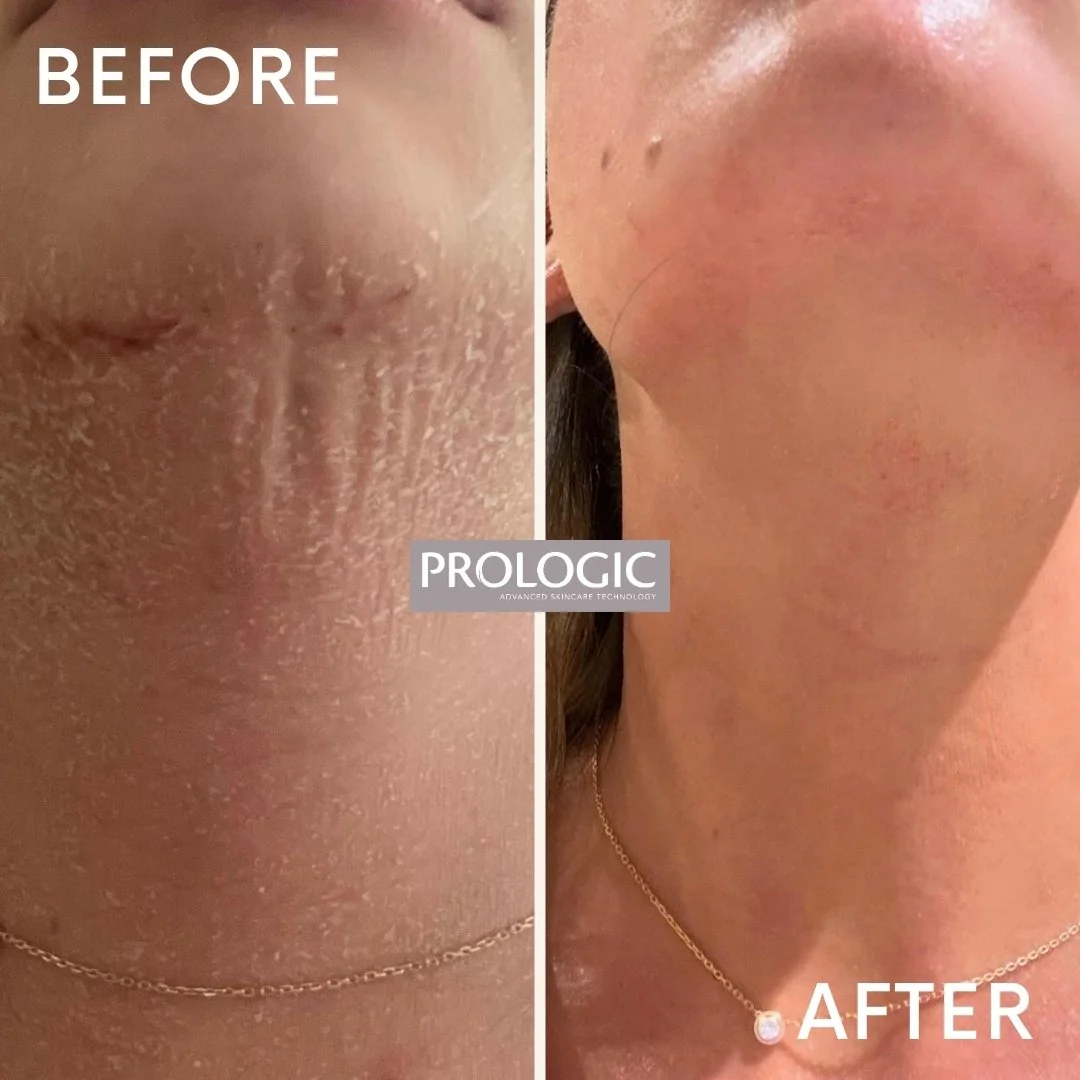 Side-by-side comparison of a person's chin and neck area before and after skincare treatment. The 'before' side shows dry, flaky skin with visible irritation, while the 'after' side shows smoother, clearer skin with reduced redness.