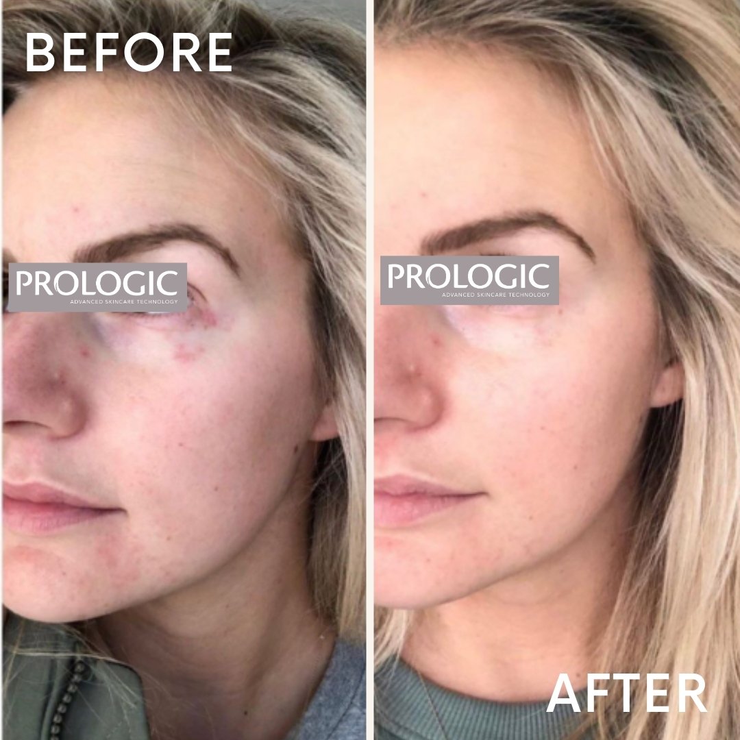 Split-screen image showing a woman's face before and after skincare treatment, labeled 'BEFORE' on the left and 'AFTER' on the right, with visible improvement in skin clarity and texture.