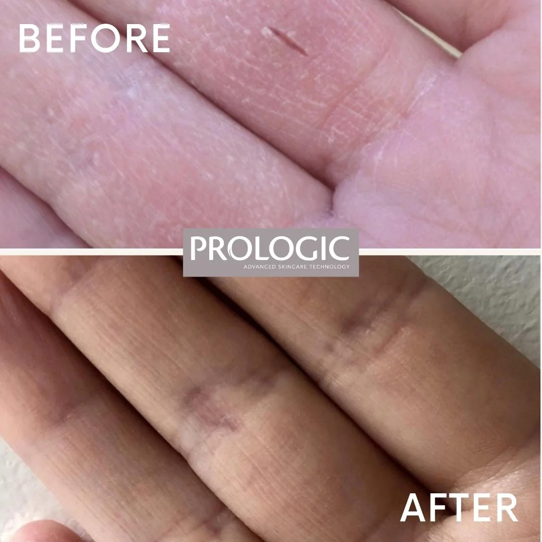 Close-up of a hand before and after skincare treatment showing improvements in skin texture and appearance, with the "before" image at the top and the "after" image at the bottom.