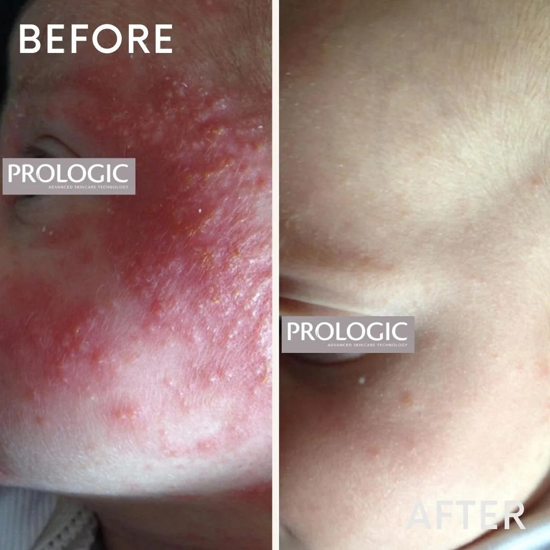 Side-by-side comparison of skin before and after treatment. The 'before' side shows red, irritated, and inflamed skin with visible blemishes, while the 'after' side displays clear, smooth, and healthy skin.