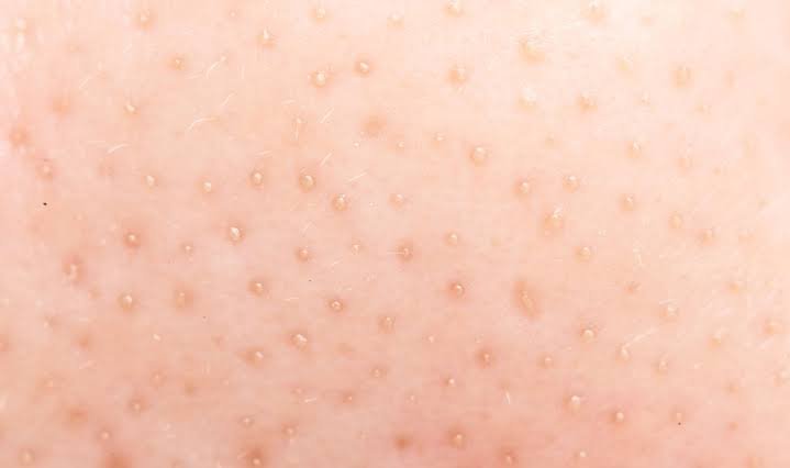 Filamentele Sebacee