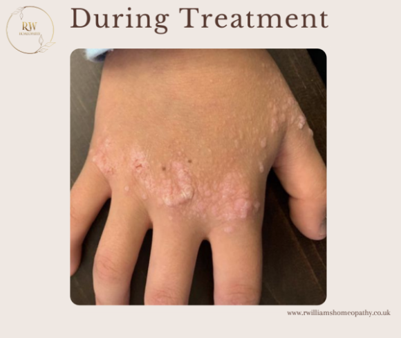 A close-up of a hand with skin treated for a skin condition, showing pink, inflamed patches and pustules, during a skincare treatment.