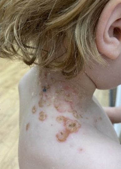 Ethan's Impetigo Journey: A Rapid Recovery with Individualised Homeopathic Treatment