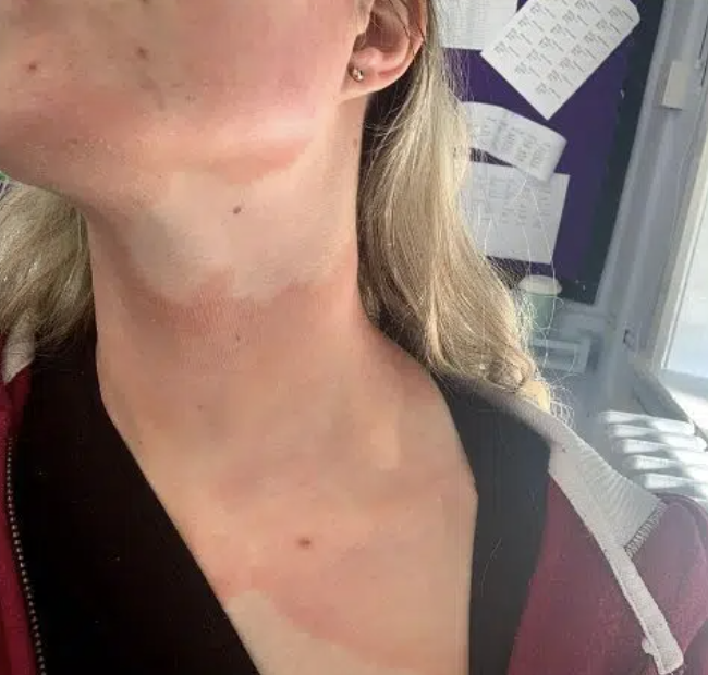 Olivia's Story: Finding Relief from a Long-Term Skin Condition with Homeopathy