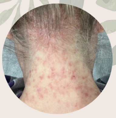 Back of a person's neck with red rash and irritation.