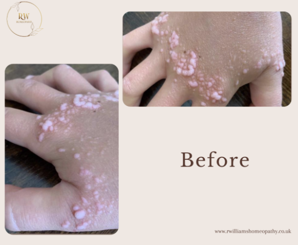 Close-up images of a hand and back showing skin conditions with pink and white patches before treatment.