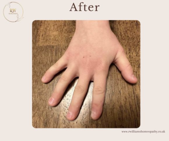 A person's hand pressed flat on a wooden surface showing the after-effects of a treatment, with the fingers spread apart.