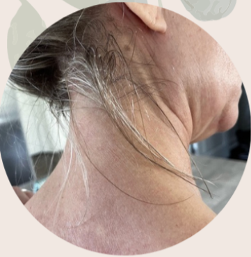Close-up of a person's neck and jawline, showing loose skin and wrinkles.
