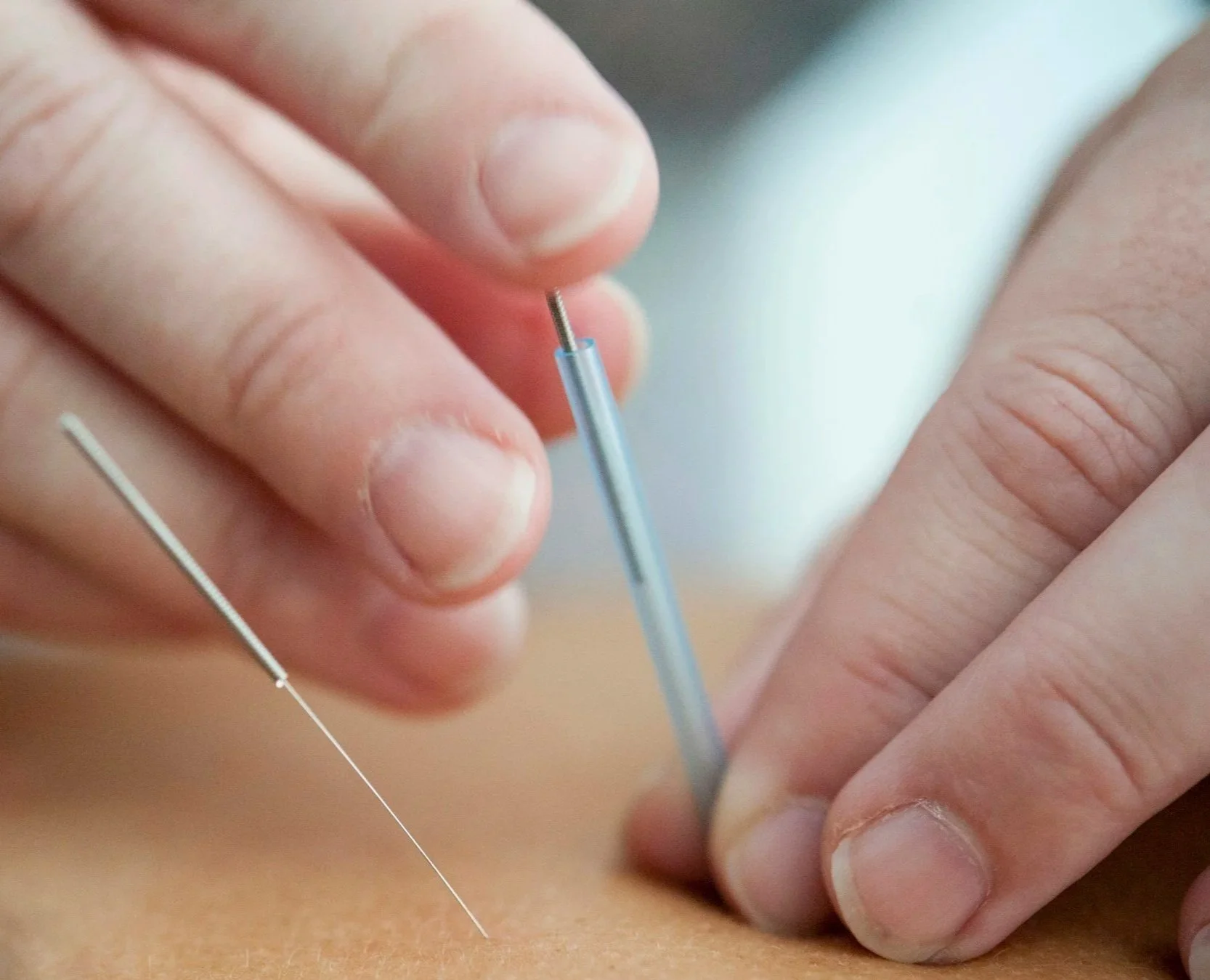 A person performing acupuncture, inserting a thin needle into the skin.