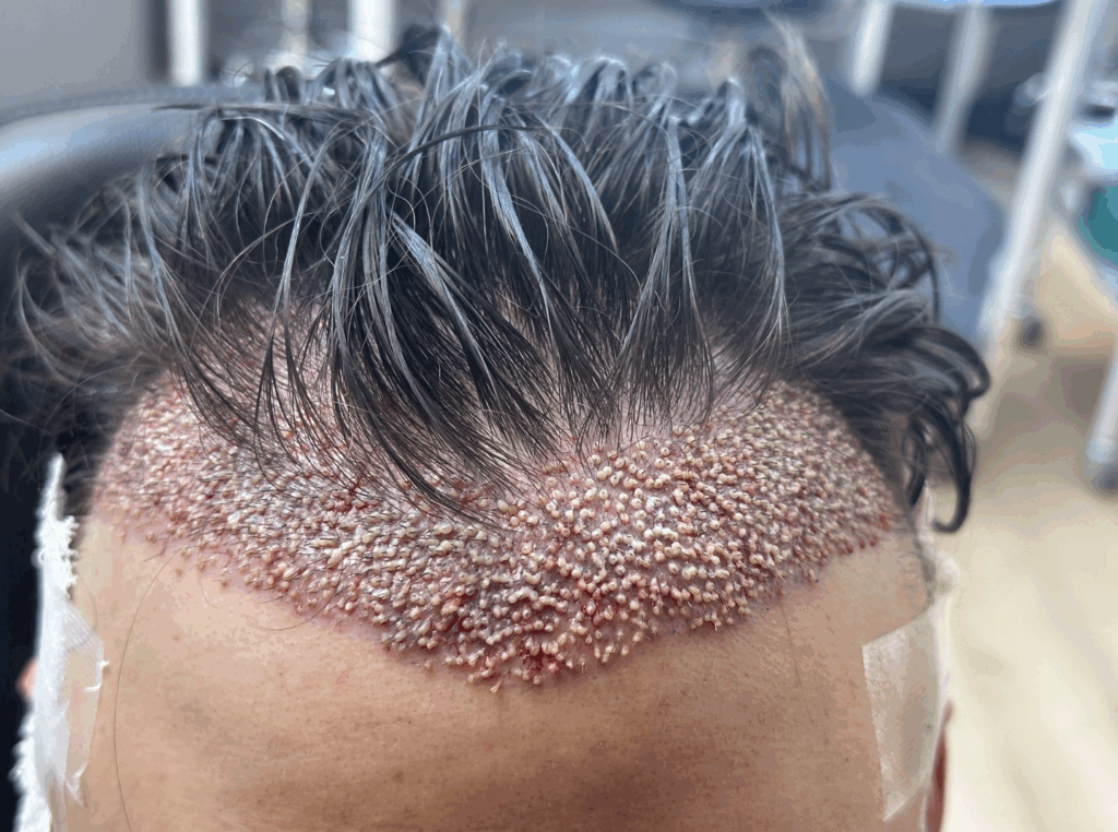 hair transplant.png