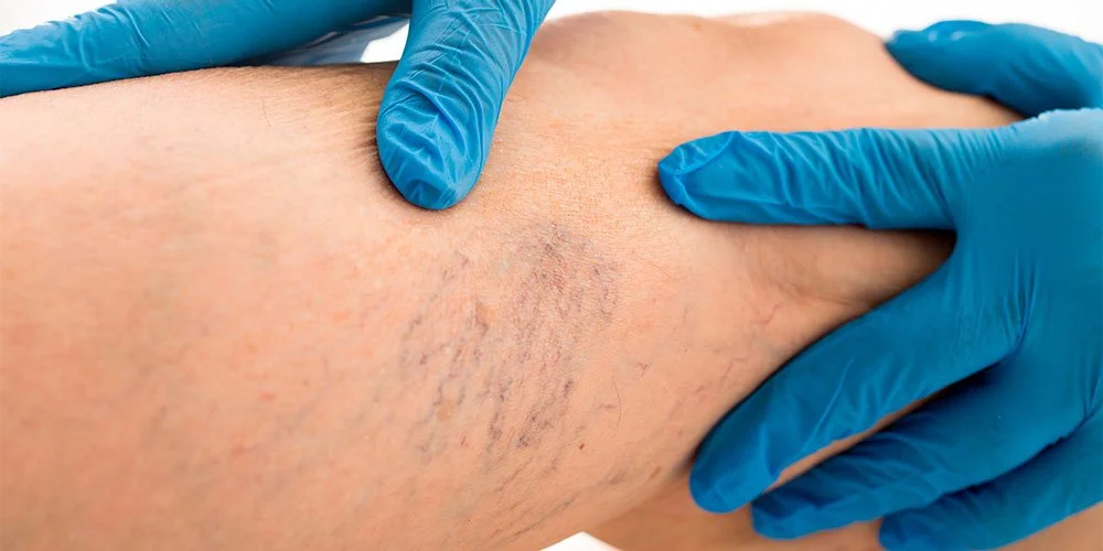 thread vein removal.jpeg