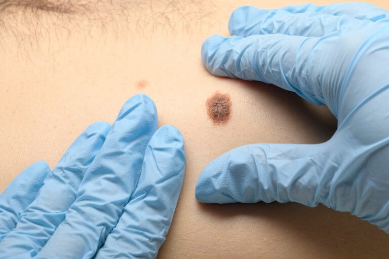 Visual-examination-of-moles-for-detecting-malignant-neoplasms-to-prevent-skin-cancer-and-melanoma-768x511.jpg