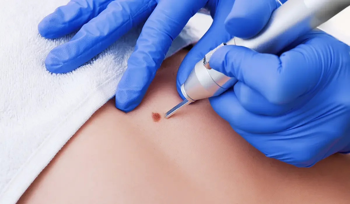 Skin-Lesion-Removal.webp
