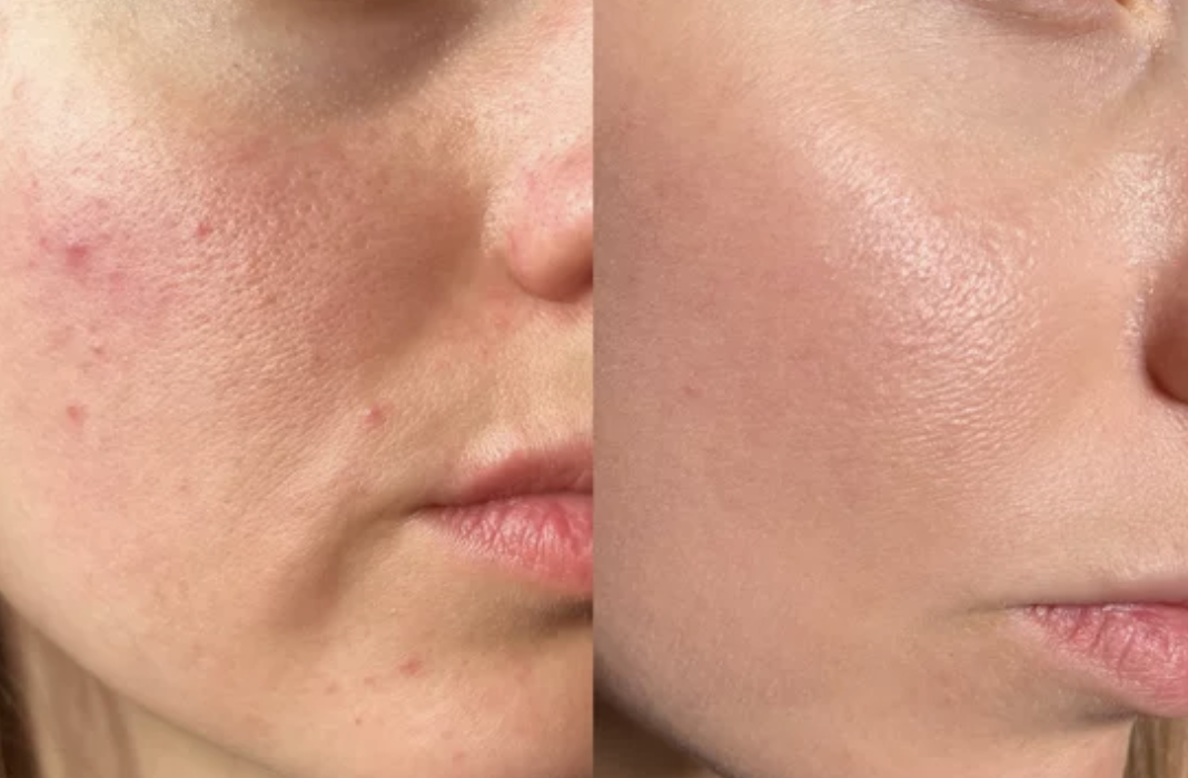 Skin Boosters vs Polynucleotides: Which Enhances Your Glow?