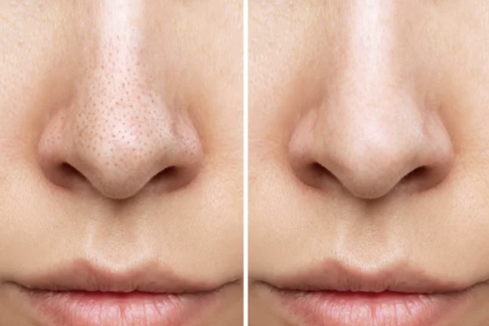 Enhance Your Natural Beauty: Microneedling or Advanced Facials?
