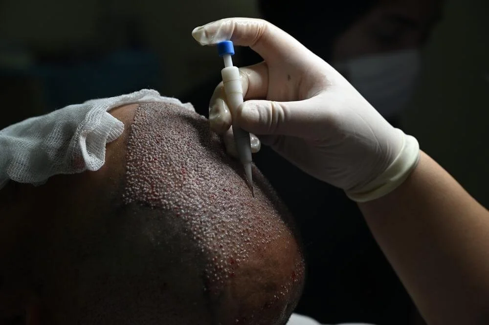 Medical procedure involving the removal of skin lesions on a patient's face with a sterile needle, in a clinical setting.