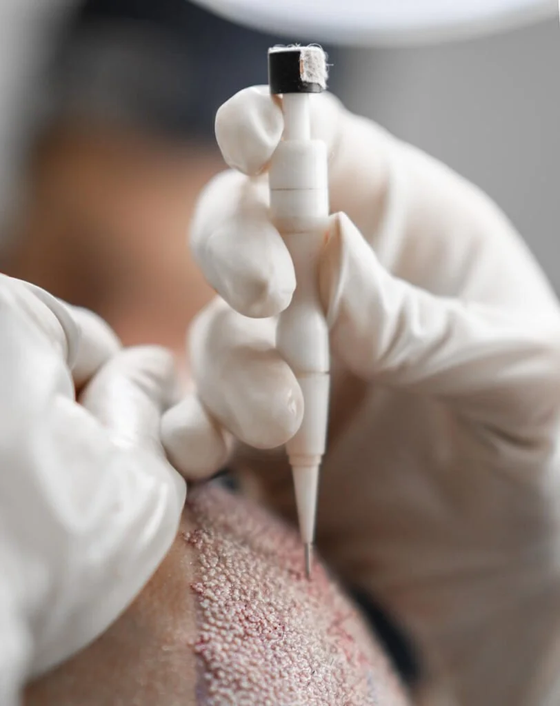 Close-up of a tattoo needle pricking skin during tattooing process, with a tattoo needle and gloved hand visible.