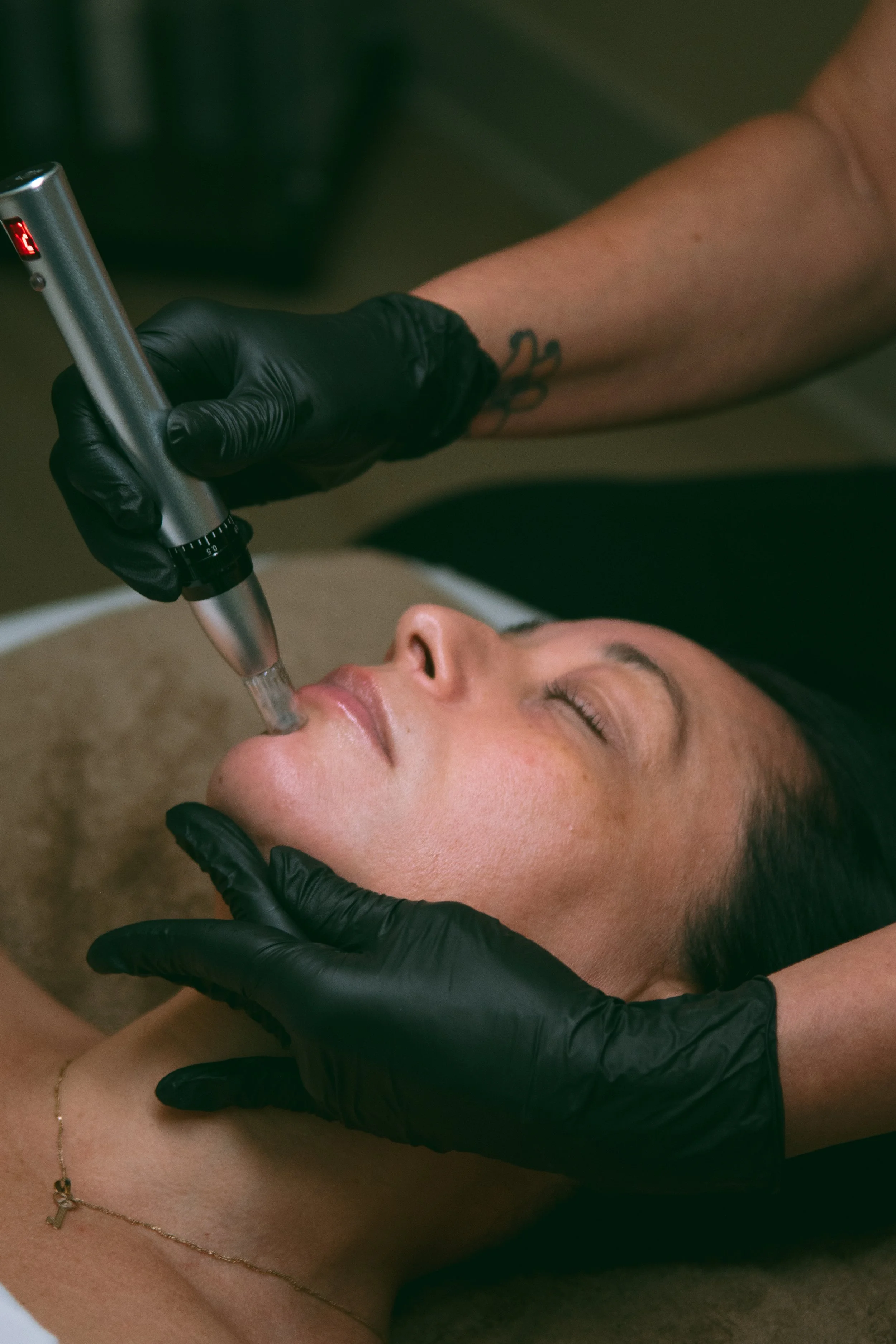 MICRONEEDLING
