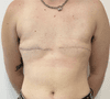 Gender Affirmation Surgery