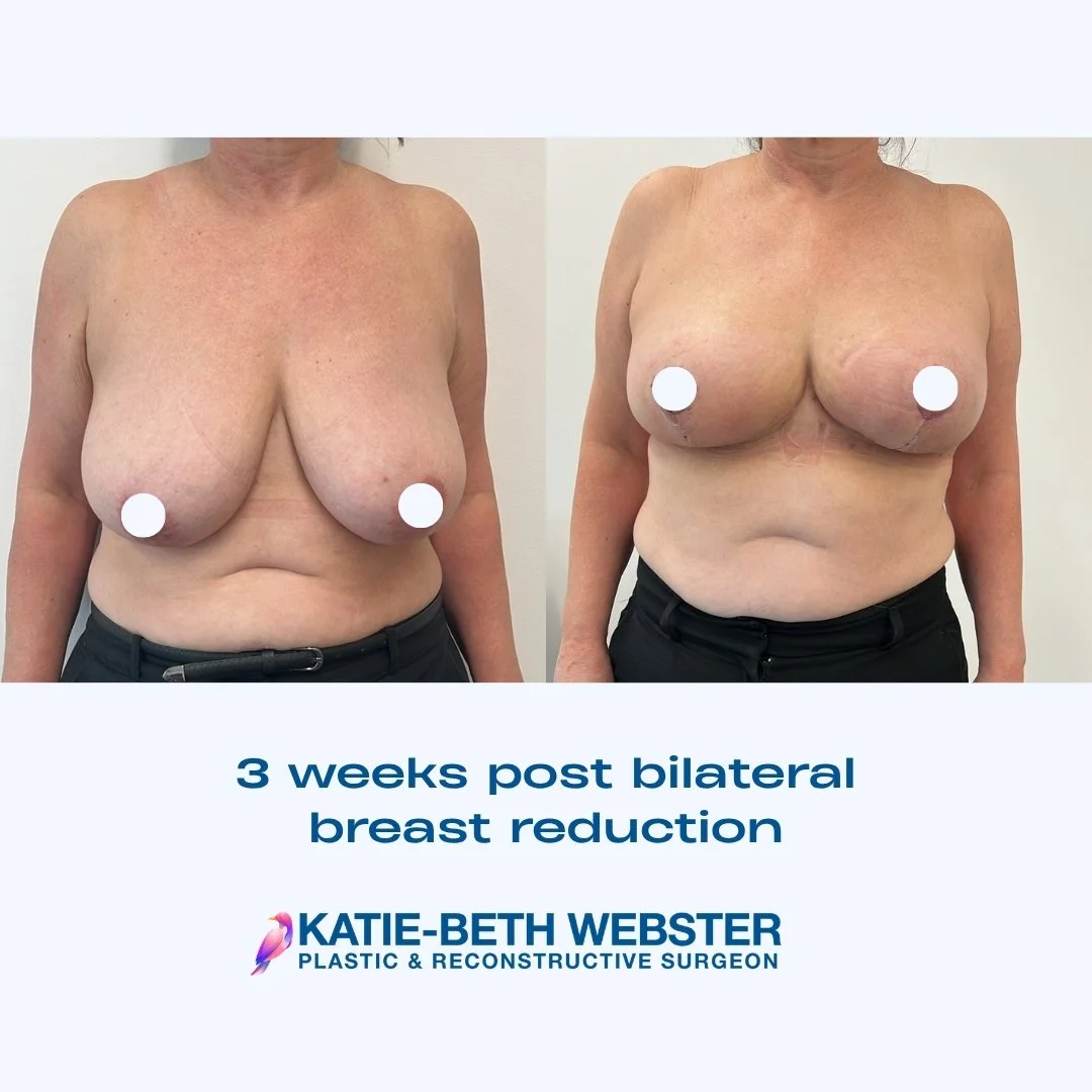 Before and after images of a woman showing her chest, three weeks after bilateral breast reduction surgery by Dr. Katie-Beth Webster, plastic and reconstructive surgeon.