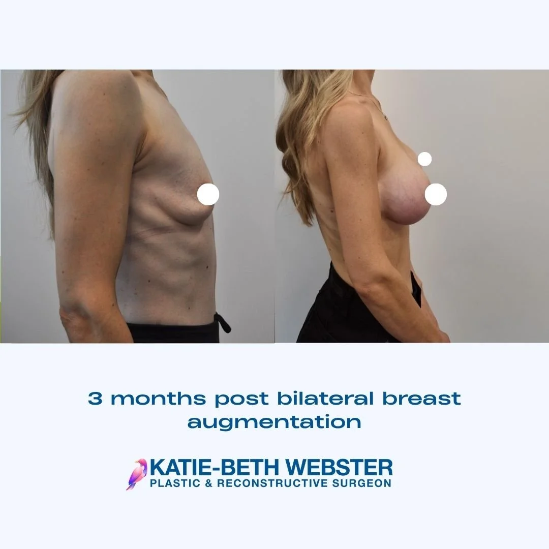 Side-by-side before and after photos showing a woman's chest 3 months post breast augmentation, showing an increase in size