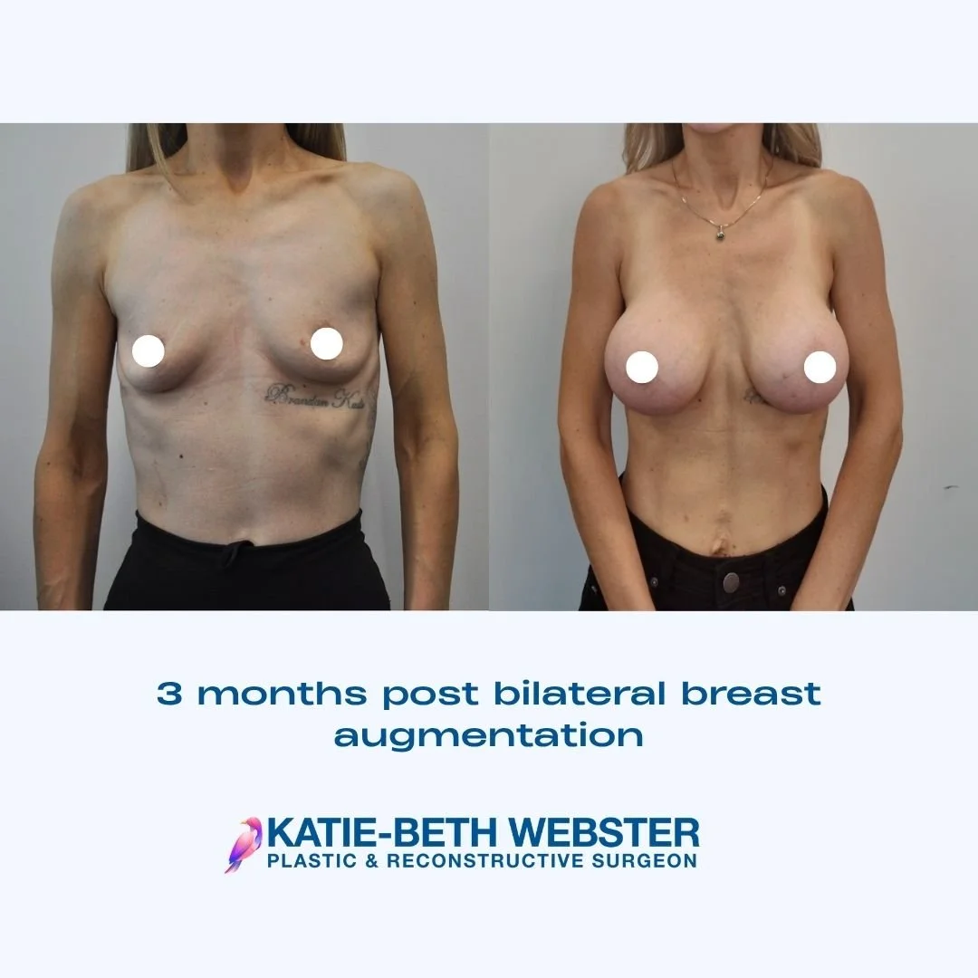 Before and after images of a woman showing her chest, three months after bilateral breast augmentation surgery by Dr. Katie-Beth Webster, plastic and reconstructive surgeon.