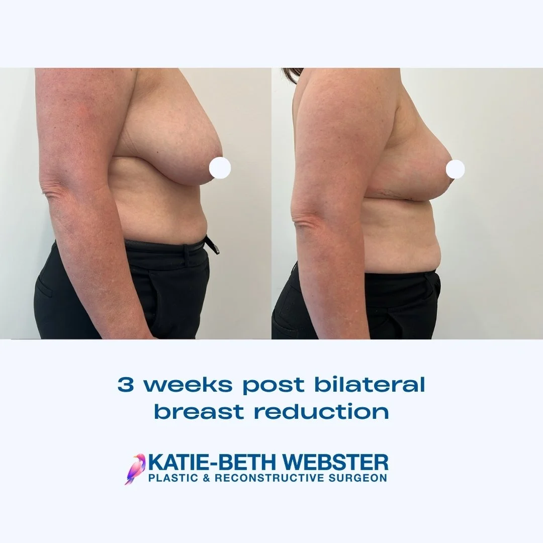 Side-by-side before and after photos showing a woman's chest 3 weeks post bilateral breast reduction, with visible reduction in breast size.