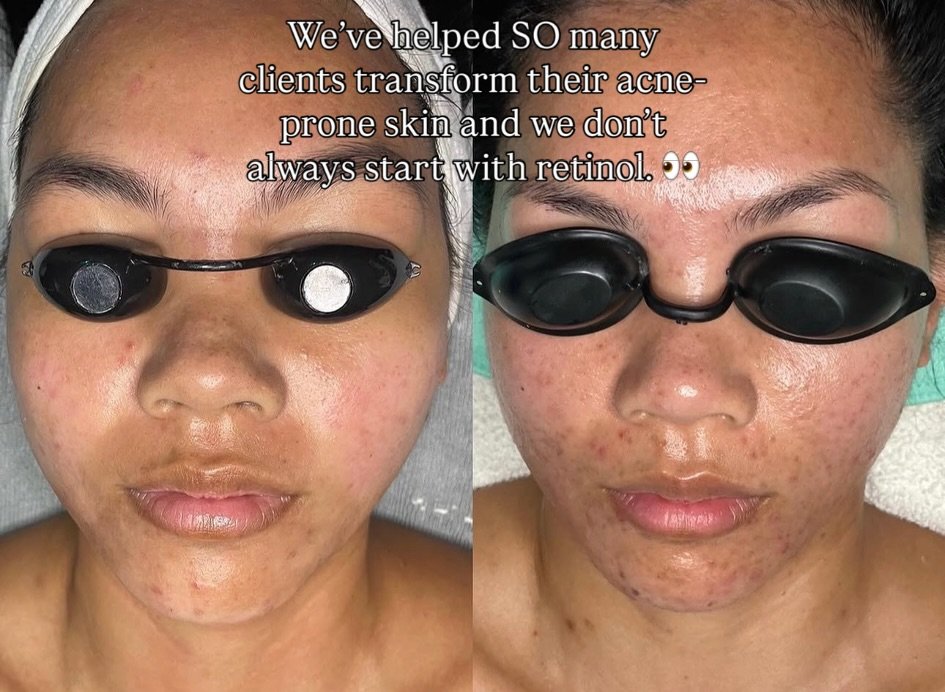 These results didn&rsquo;t come from throwing every trending acne ingredient at their skin. They came from customized routines, professional treatments, consistency + knowing when to PUSH the skin and when to PROTECT it.

Because after helping so man