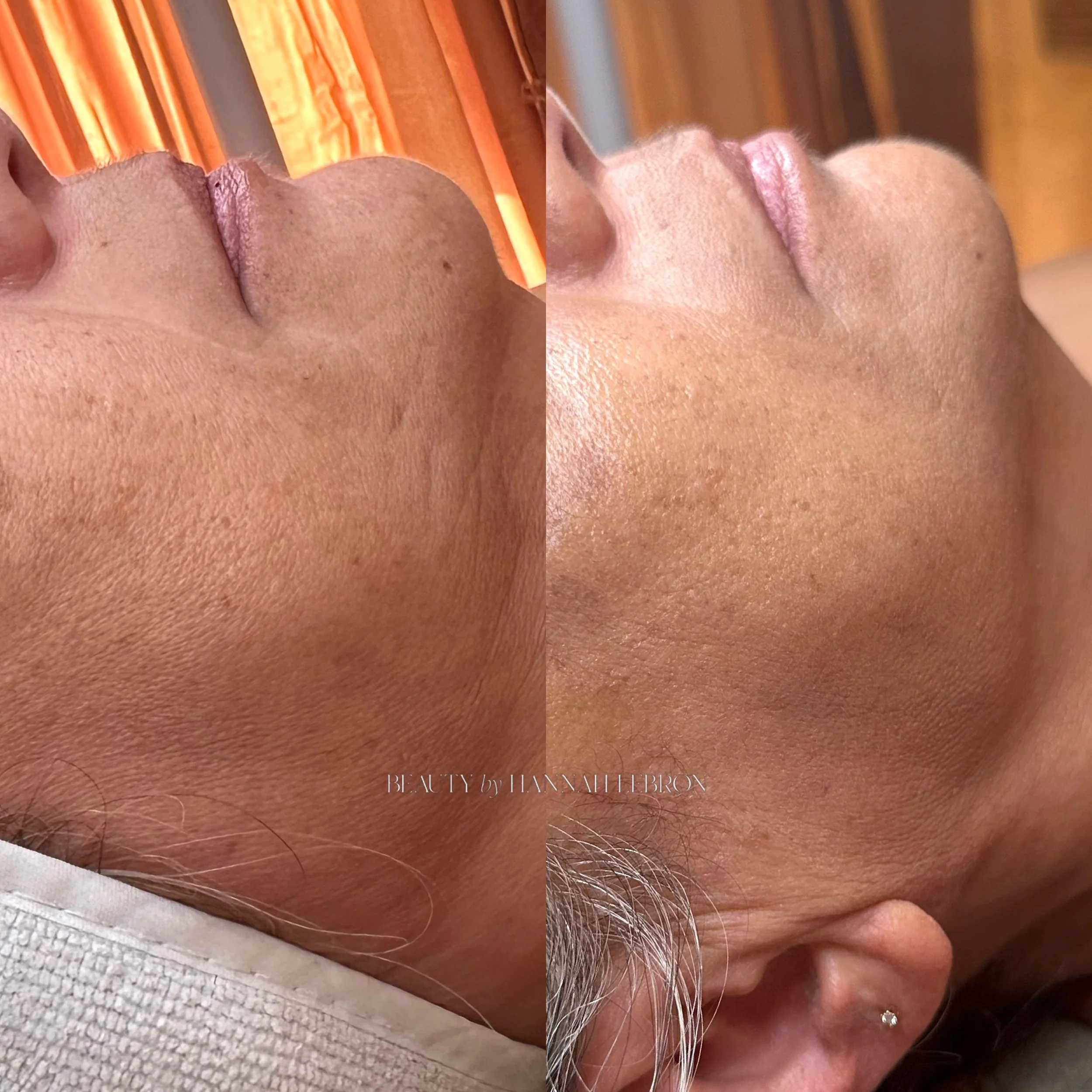 The last time my mama came to visit we did the works on her. This is after just ONE DMK Enzyme treatment + years of a simple DMK home care. 

I will always focus on skin function before chasing every individual concern. We&rsquo;re not trying to eras