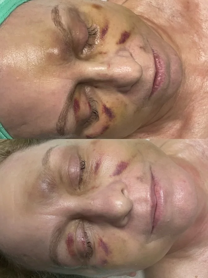 Your skin&rsquo;s needs change and we&rsquo;re here to support it through every phase. Bruising happens when small blood vessels break and leak blood beneath the skin. The discoloration fades as your body breaks down and reabsorbs that blood. 

For t