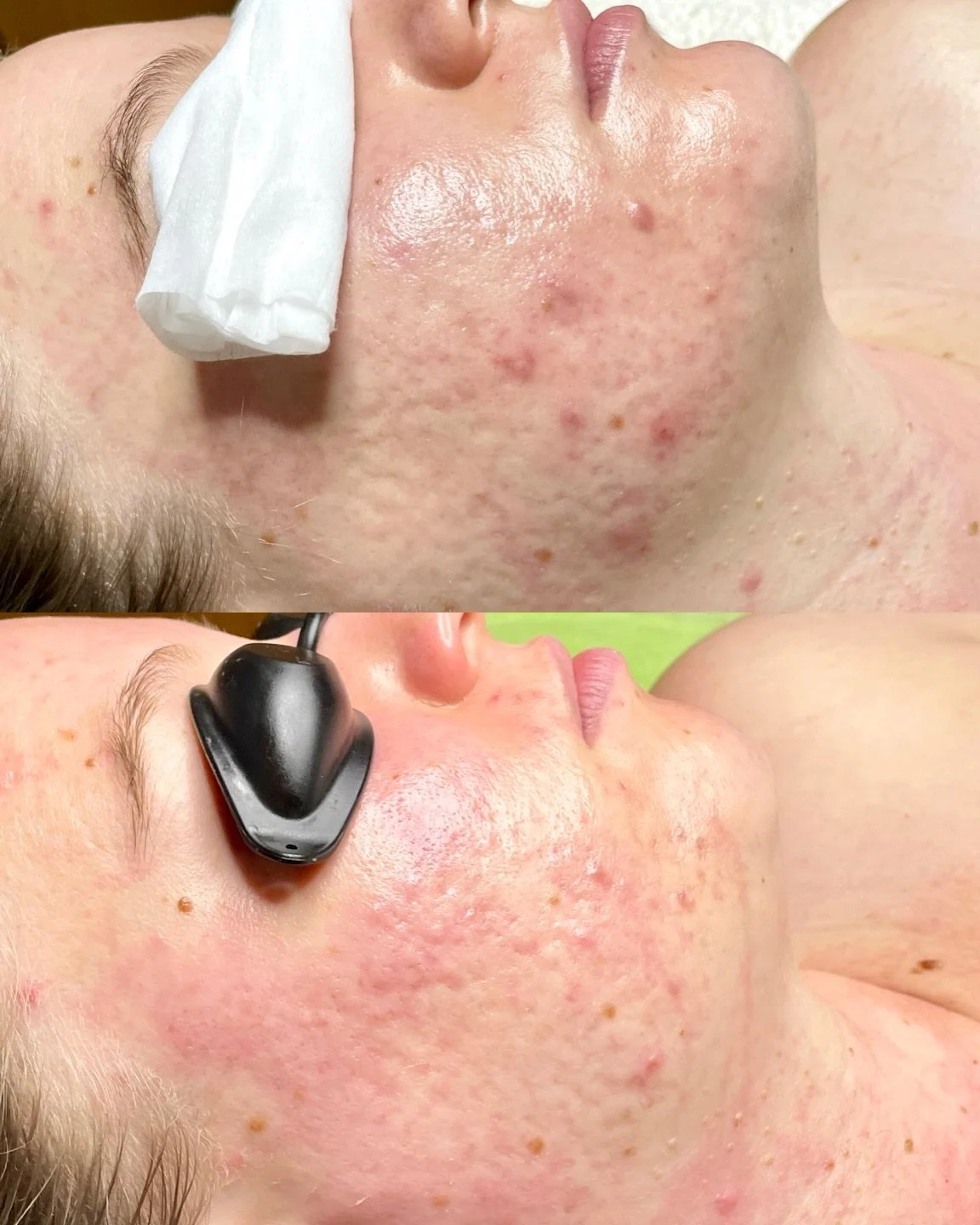 Step 1 👏🏾 
Still breaking out while trying to fade the marks left behind? Your skin needs a plan and the order matters.

Acne begins when oil and dead skin cells clog the follicle, triggering inflammation. That inflammation can leave lingering red 