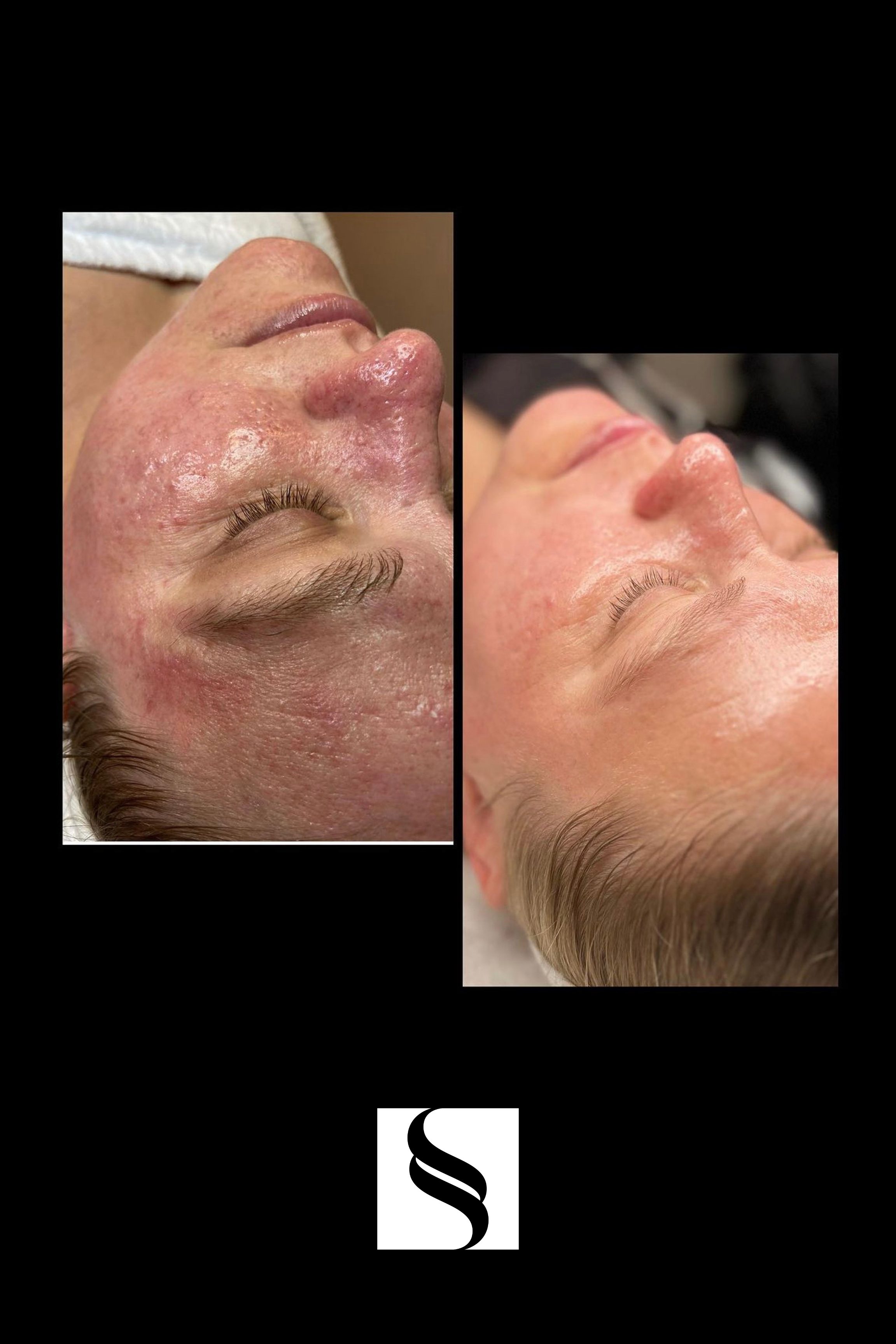 Side-by-side comparison of a person's face before and after skin treatment, showing improvement in skin condition and texture.
