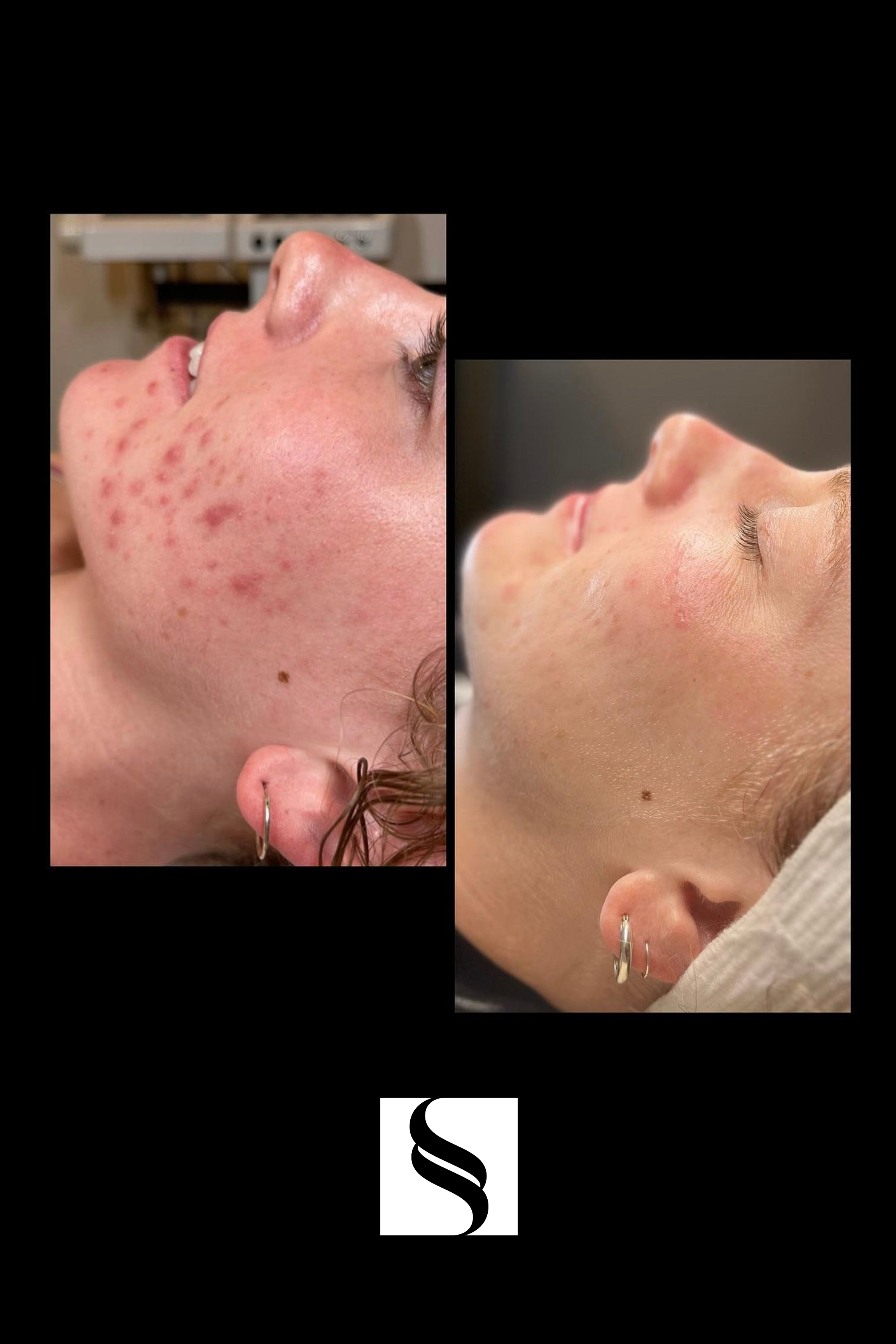 Side-by-side comparison of a woman's face before and after skincare treatment, showing improved skin condition and reduced acne.