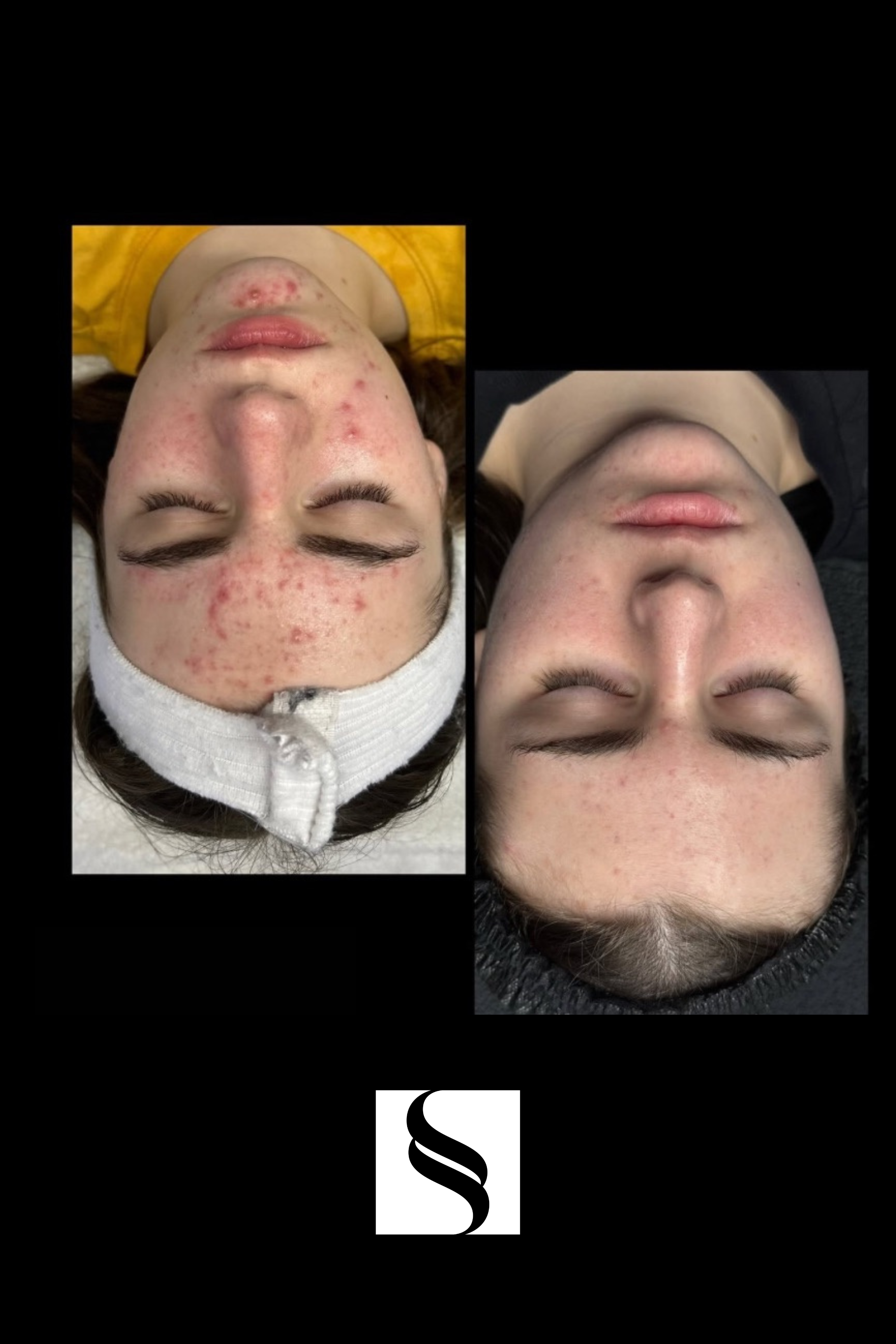 Before and after images showing the skin condition improvement of a woman with acne. The left image depicts her with inflamed, red acne lesions on her face, wearing a white headband. The right image shows her face cleared of acne, with little to no v