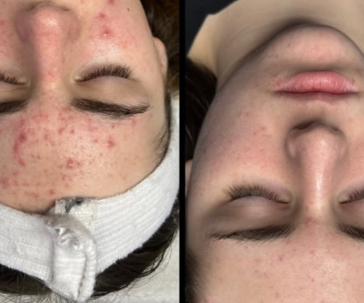 Side-by-side comparison of a person's face before and after skin treatment, showing improved skin clarity and reduced acne.