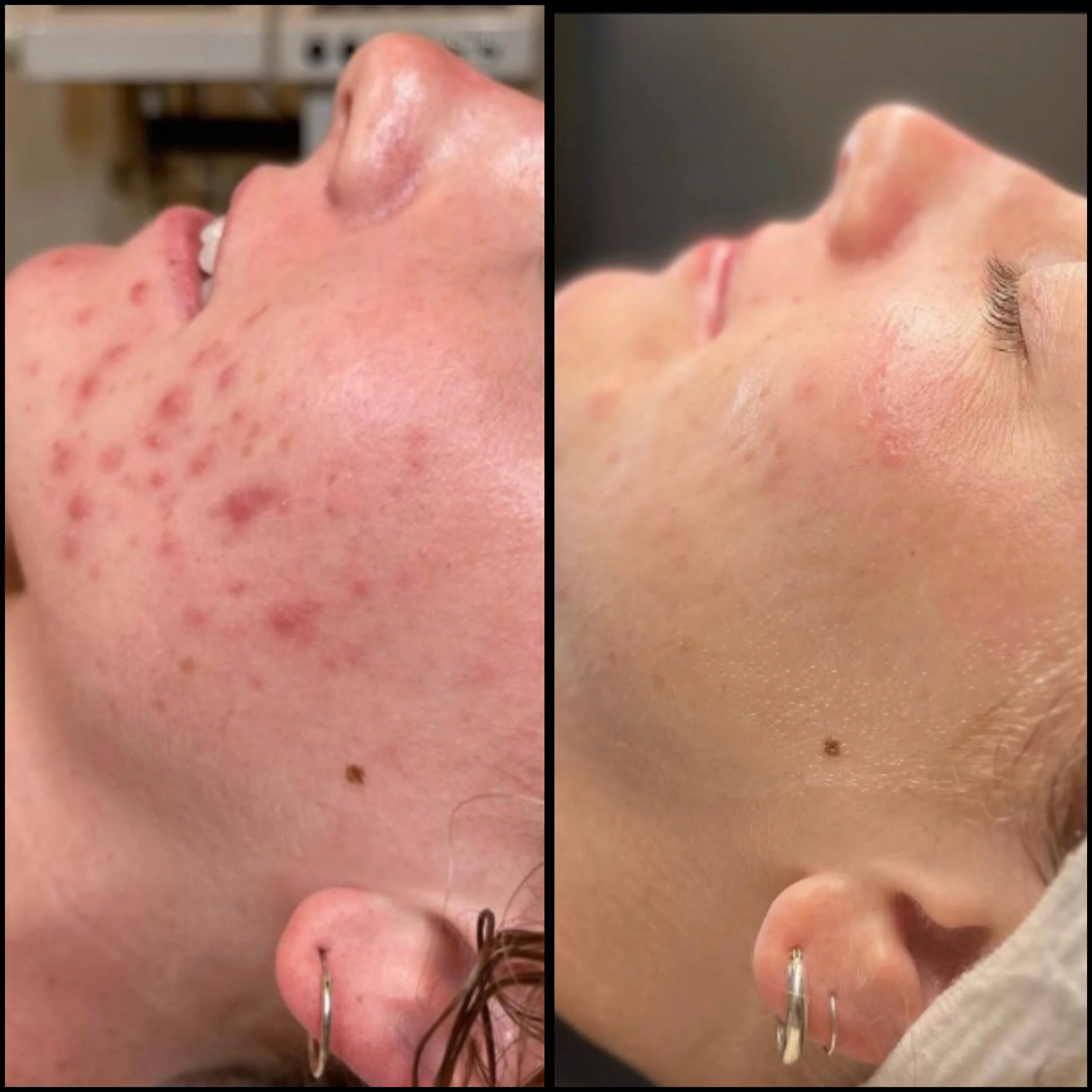 Side-by-side comparison of two close-up images of a woman's nose and face, showing before and after skin treatment. The left image shows skin with acne scars and blemishes, while the right image shows clear, smooth skin.