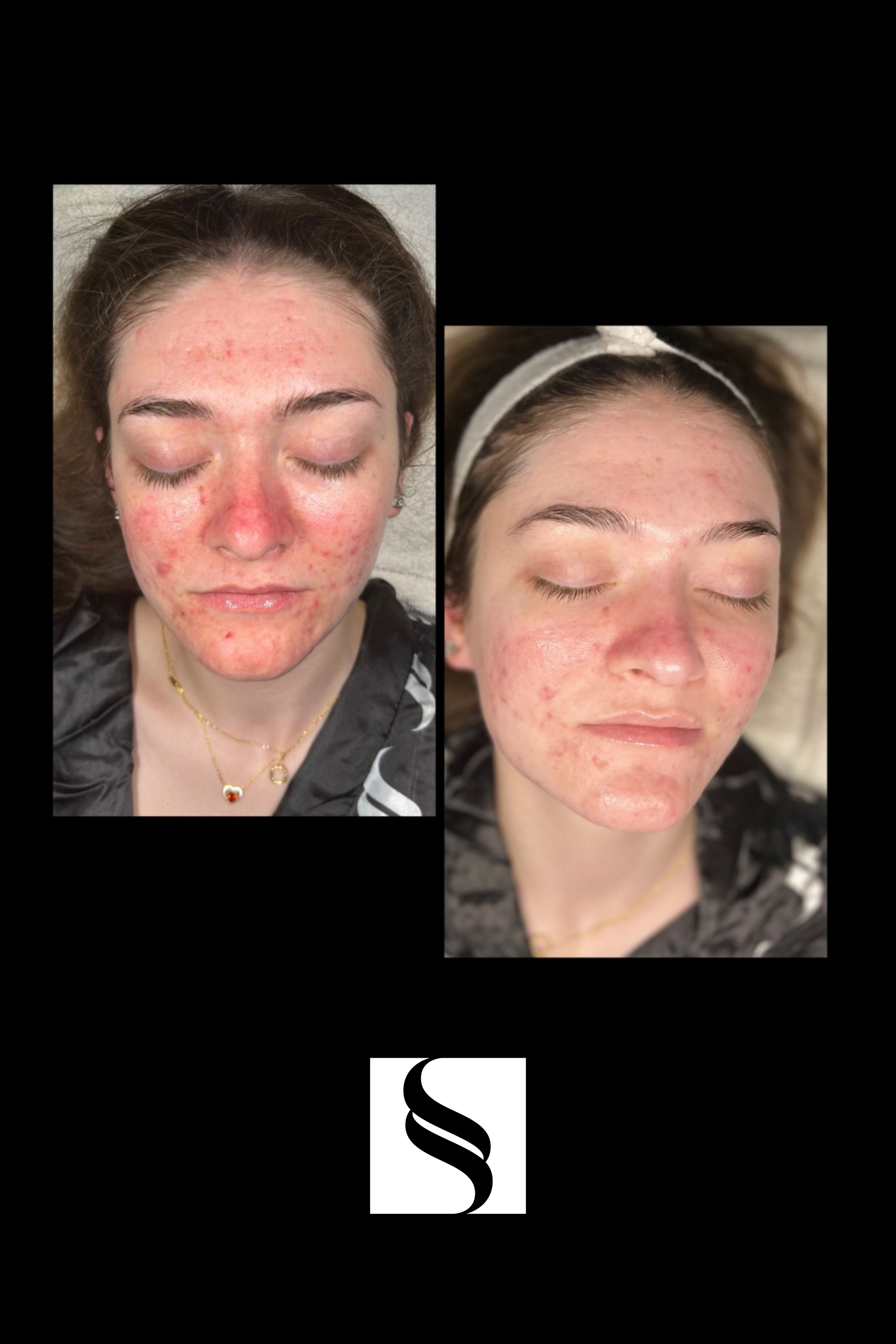 Before and after photos of a woman with improving skin condition, showing less redness and acne.