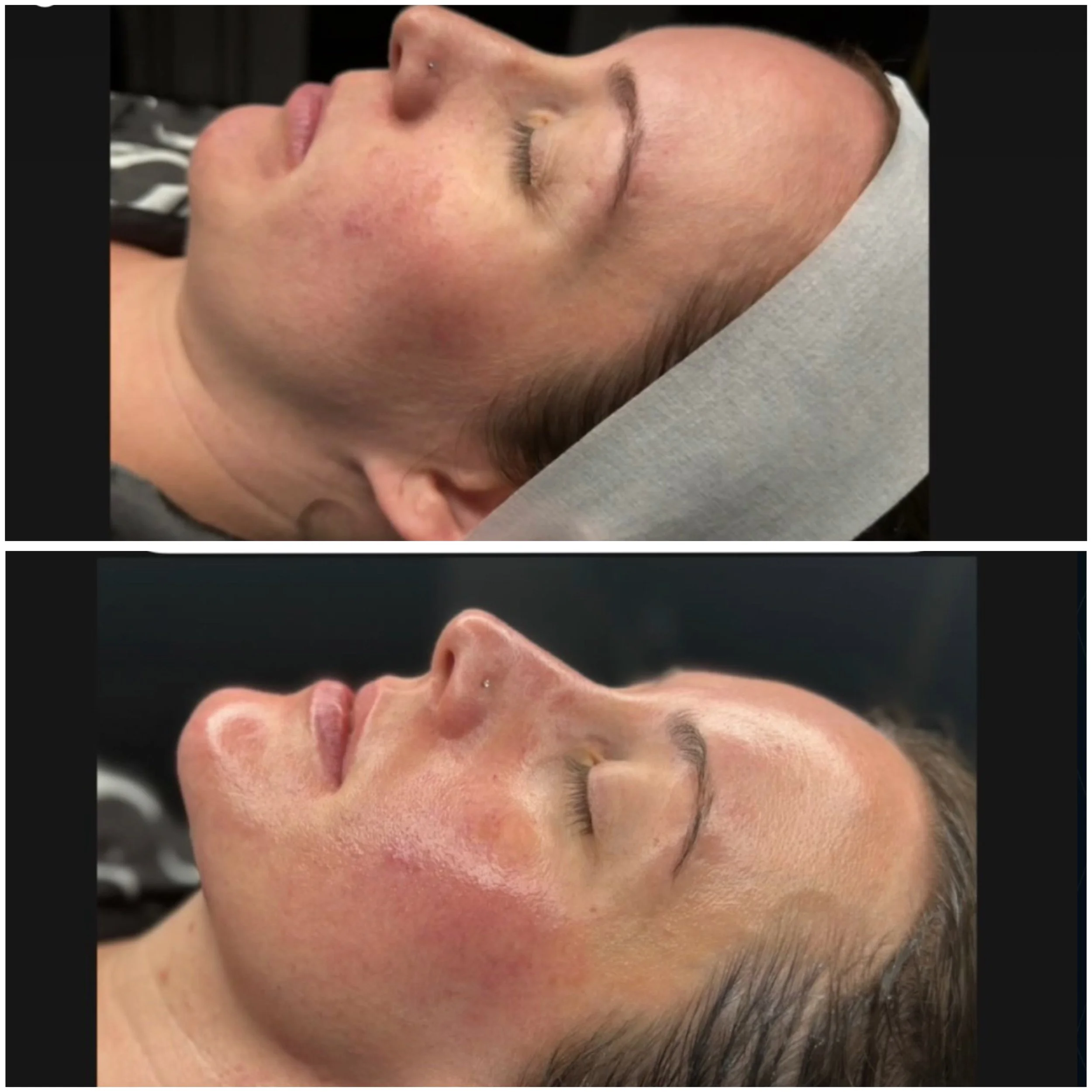 Close-up of a person's face with eyes closed, lying down with a towel or headrest under their head, showing skin redness and blemishes on cheek and forehead.
