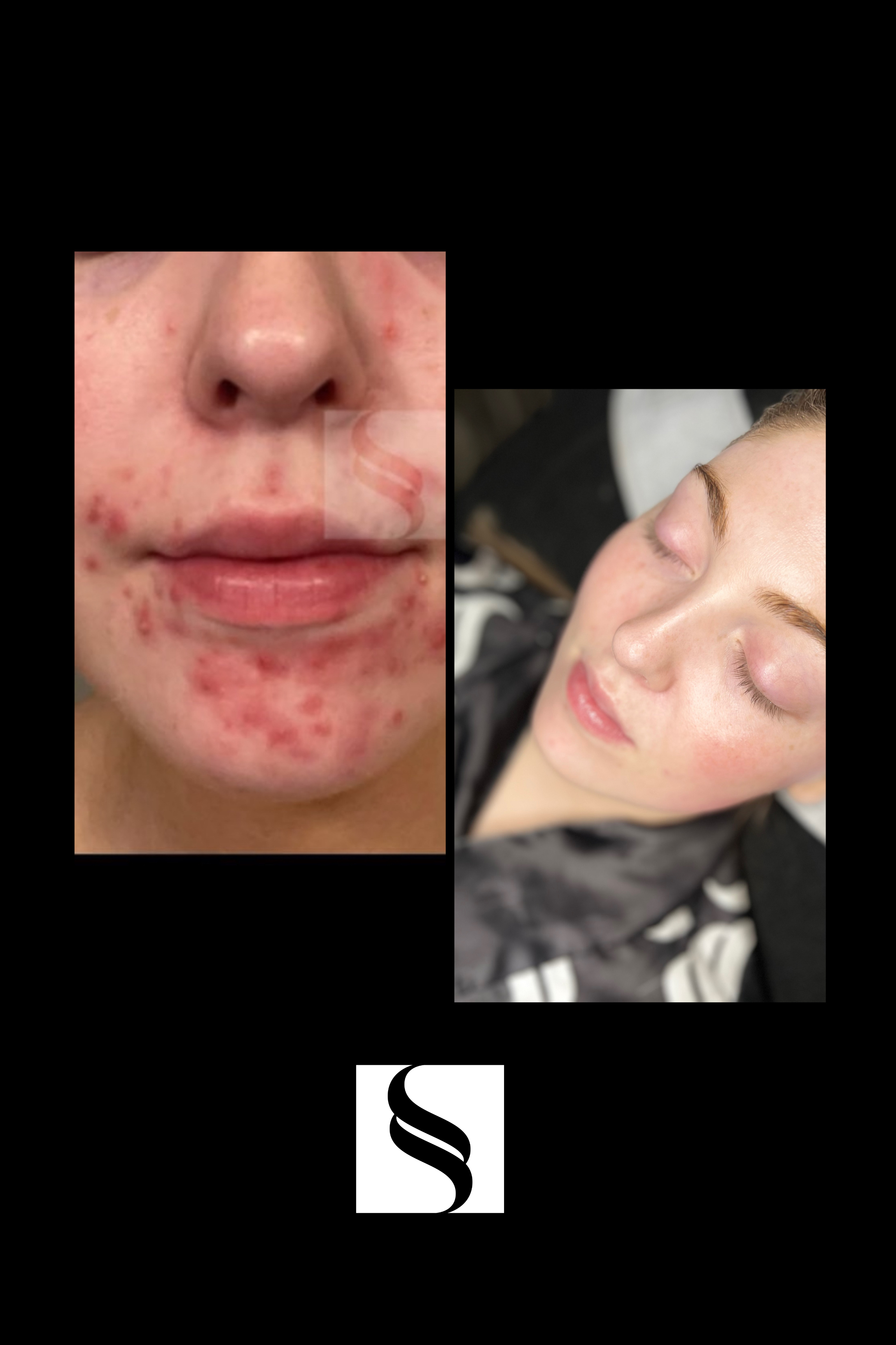 Split image showing a woman with severe acne on the left and a woman with clear skin on the right.