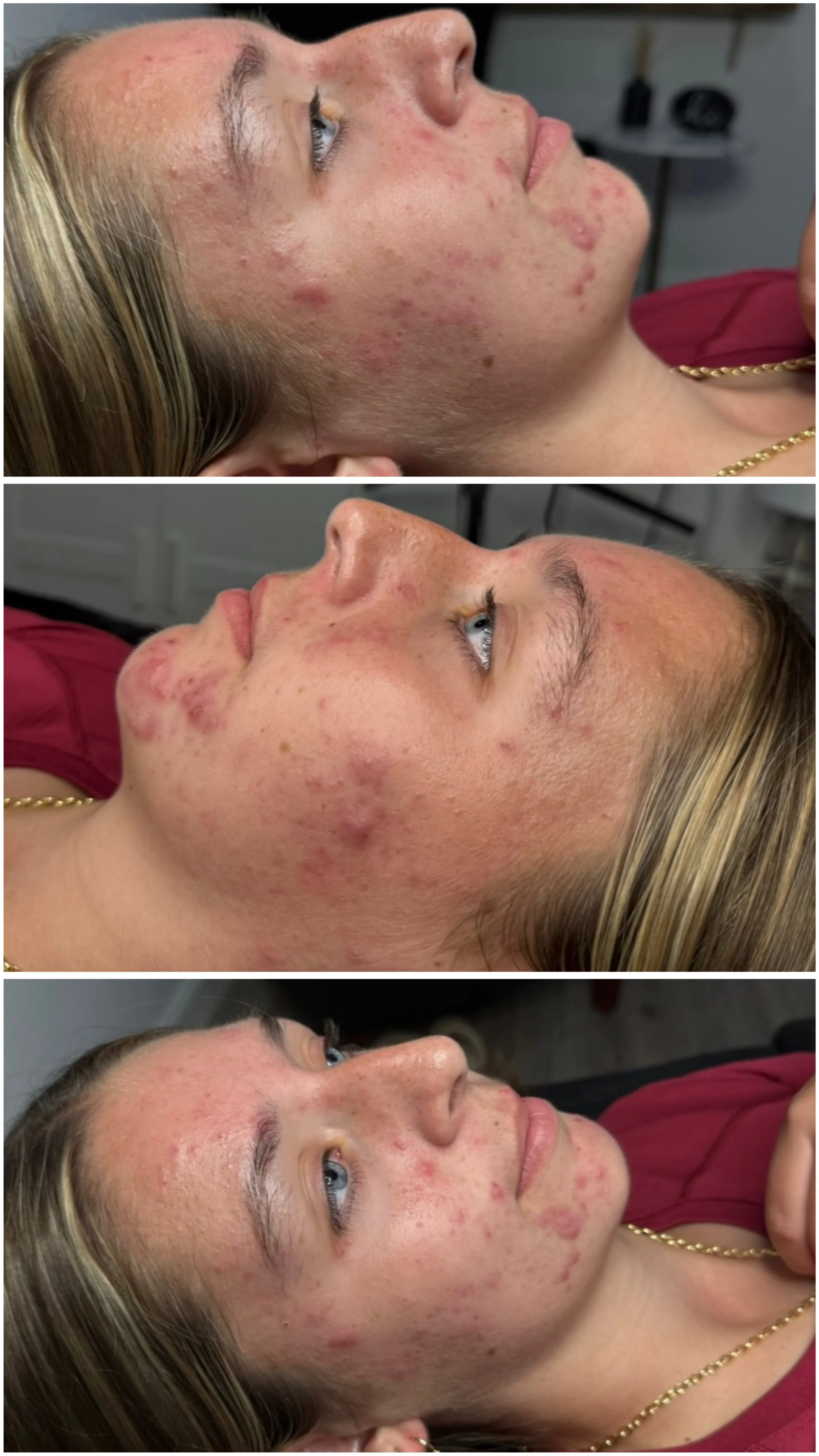 Close-up of a young woman's face showing acne and skin inflammation before skincare treatment, lying down indoors.