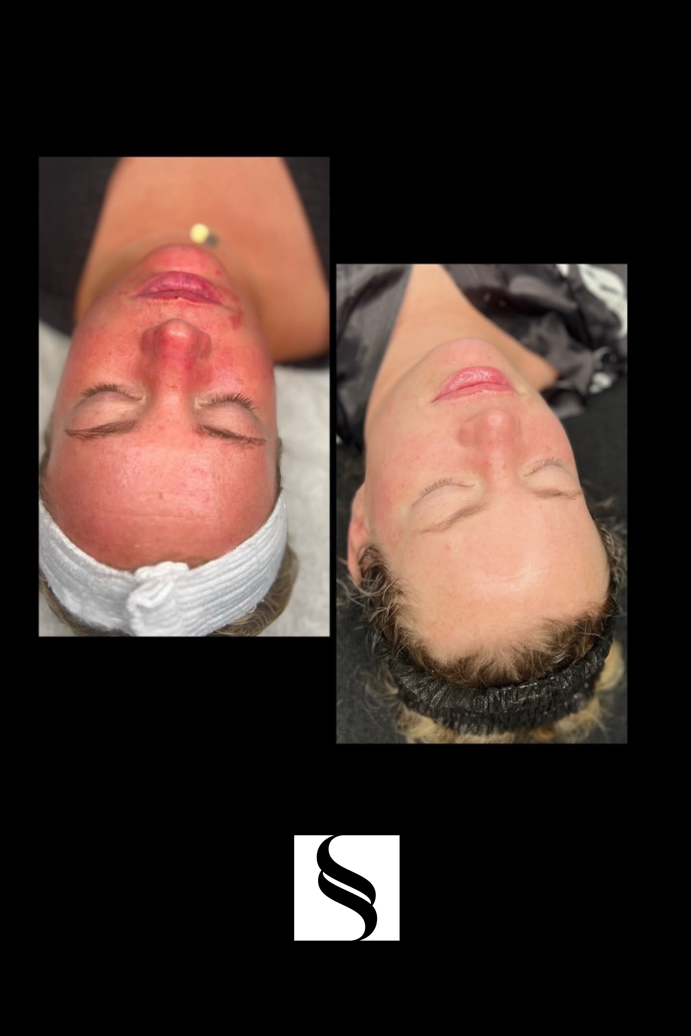 Side-by-side comparison of a woman's face before and after a facial skincare treatment. The left shows reddish, irritated skin with visible redness and inflammation. The right shows clear, smooth skin with a healthy complexion and no visible irritation.