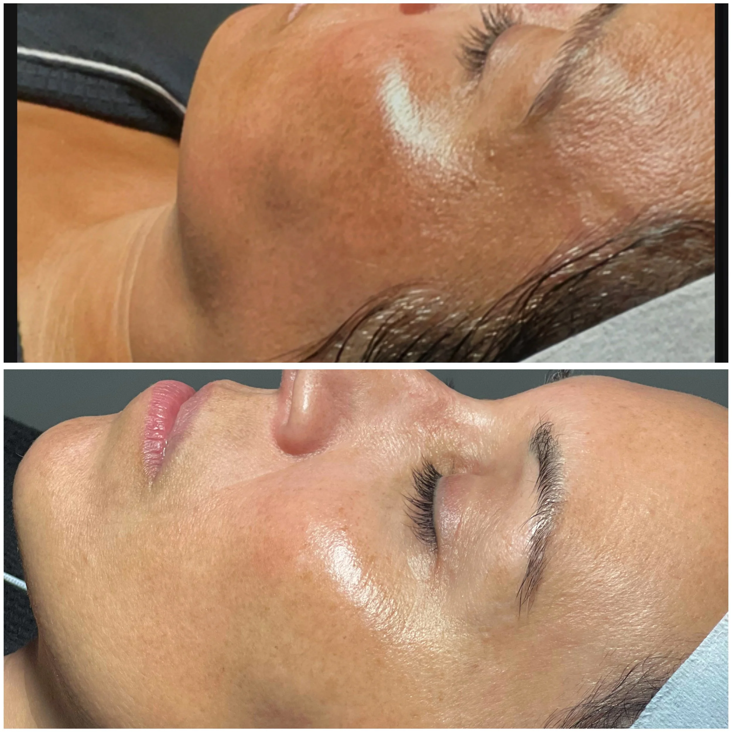 Close-up of a person's face showing the forehead, closed eye, nose, and lips. The skin appears smooth with a light complexion.