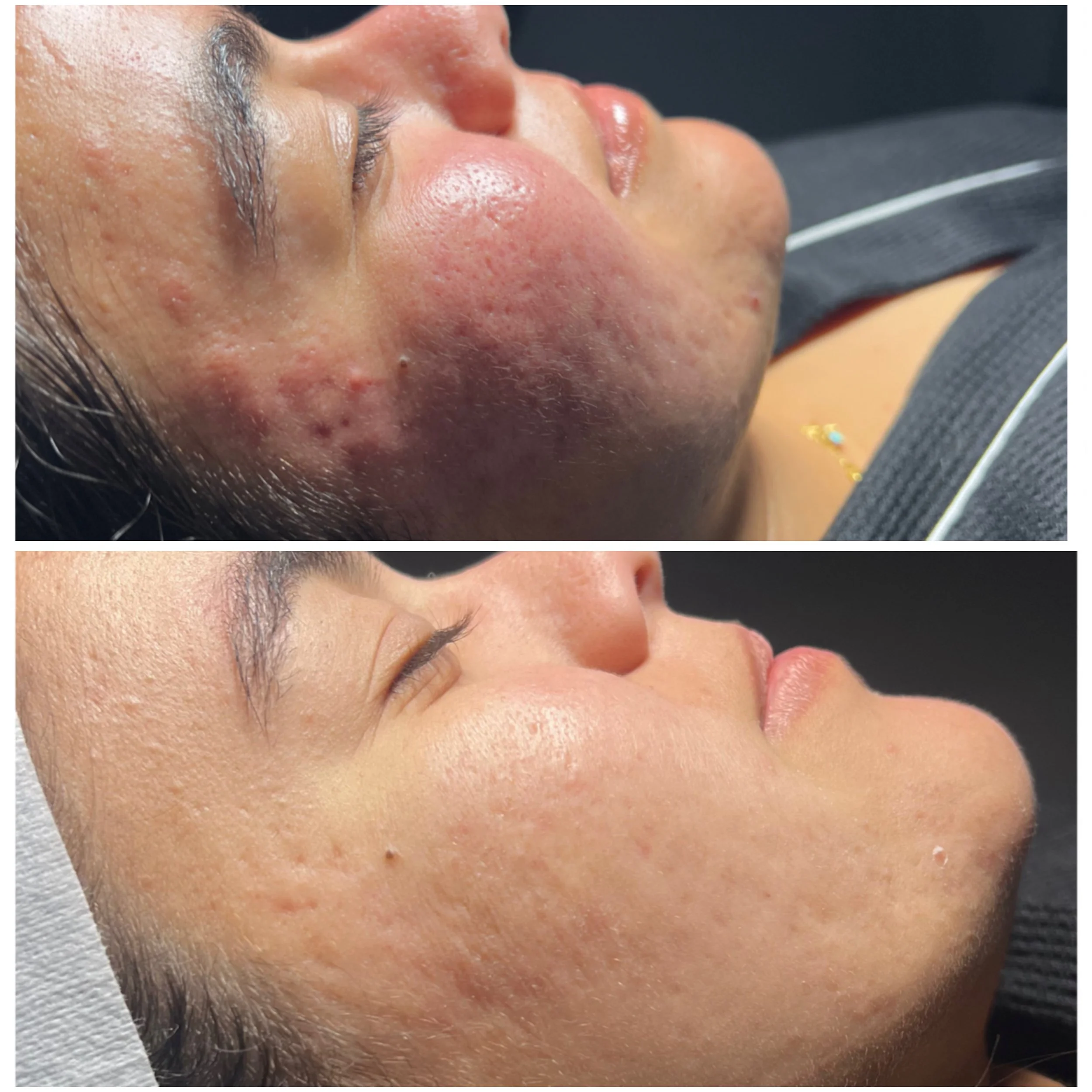 Close-up of a person's face showing red, inflamed skin, acne, and pimples on their cheeks and jawline.