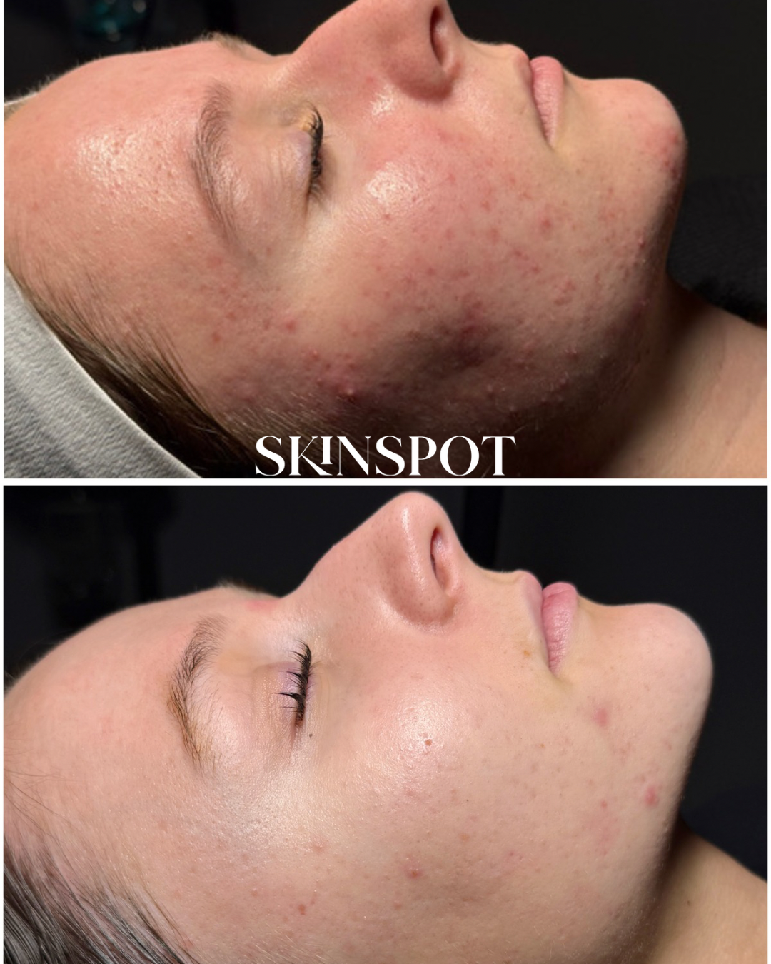 Before and after images showing a woman's face with improved skin clarity and reduced acne and redness after skincare treatment.