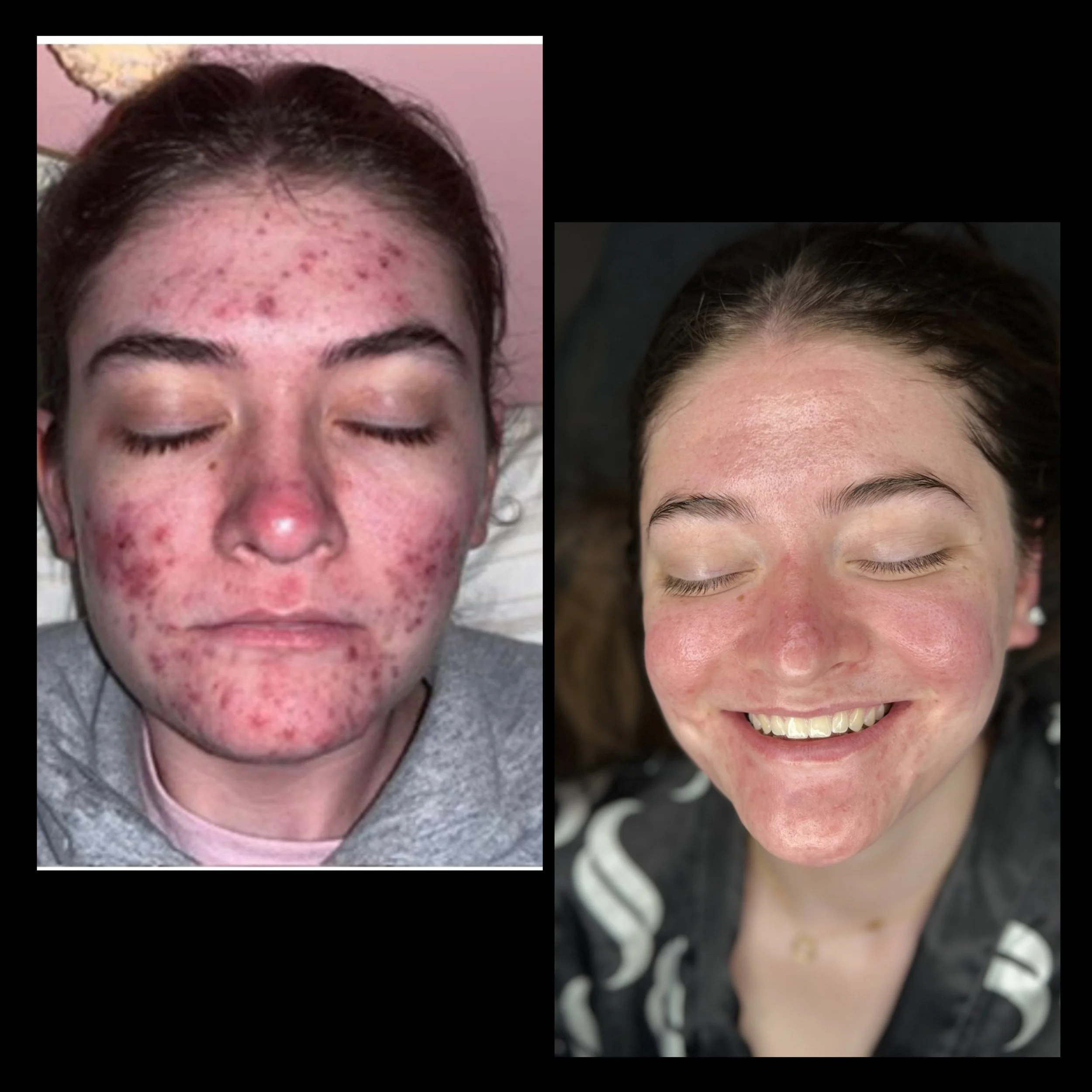 Comparison of a woman's face before and after acne treatment, showing clear skin after treatment.