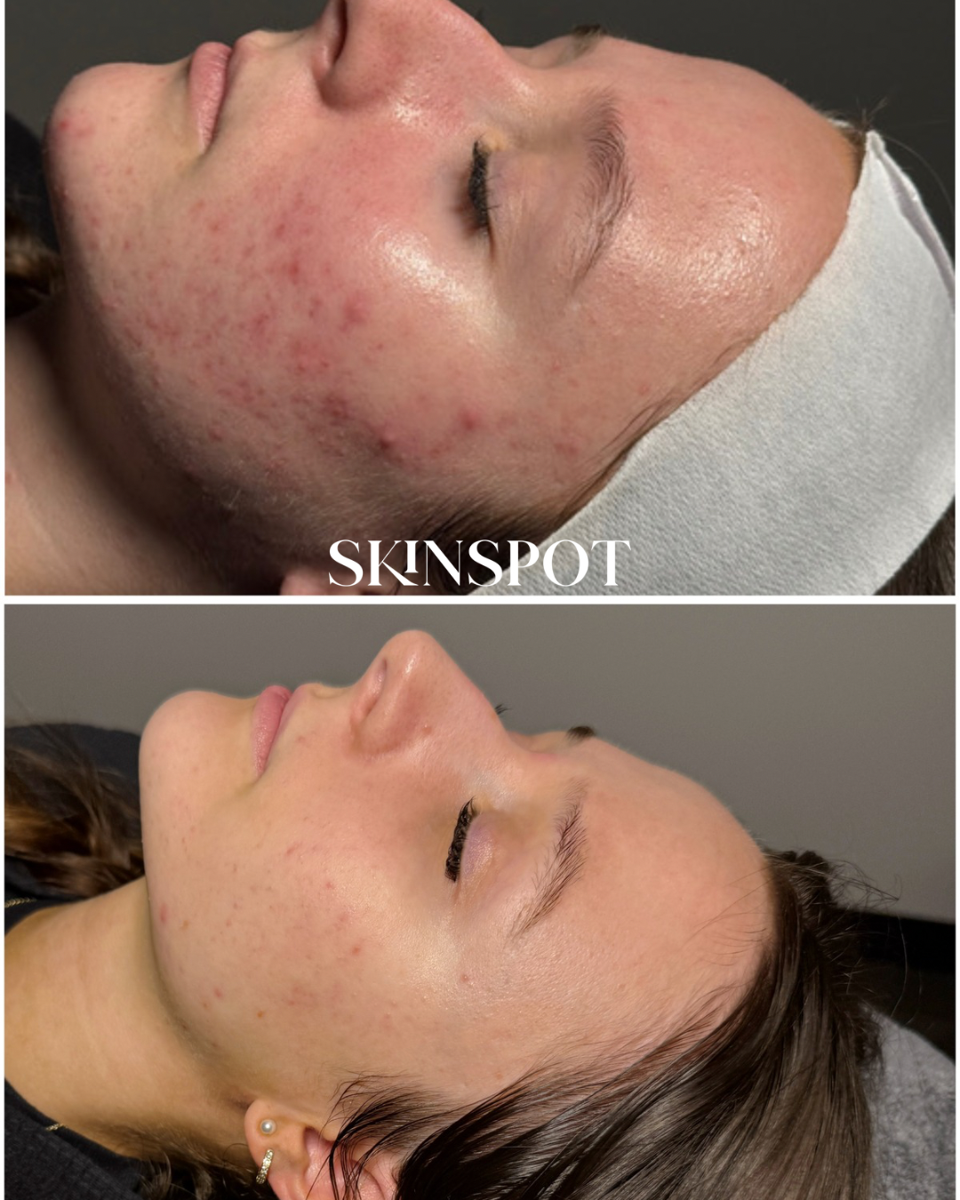 Before and after images showing a woman's face, with visible acne, before and after a skincare treatment, with significant reduction in acne and clearer skin.
