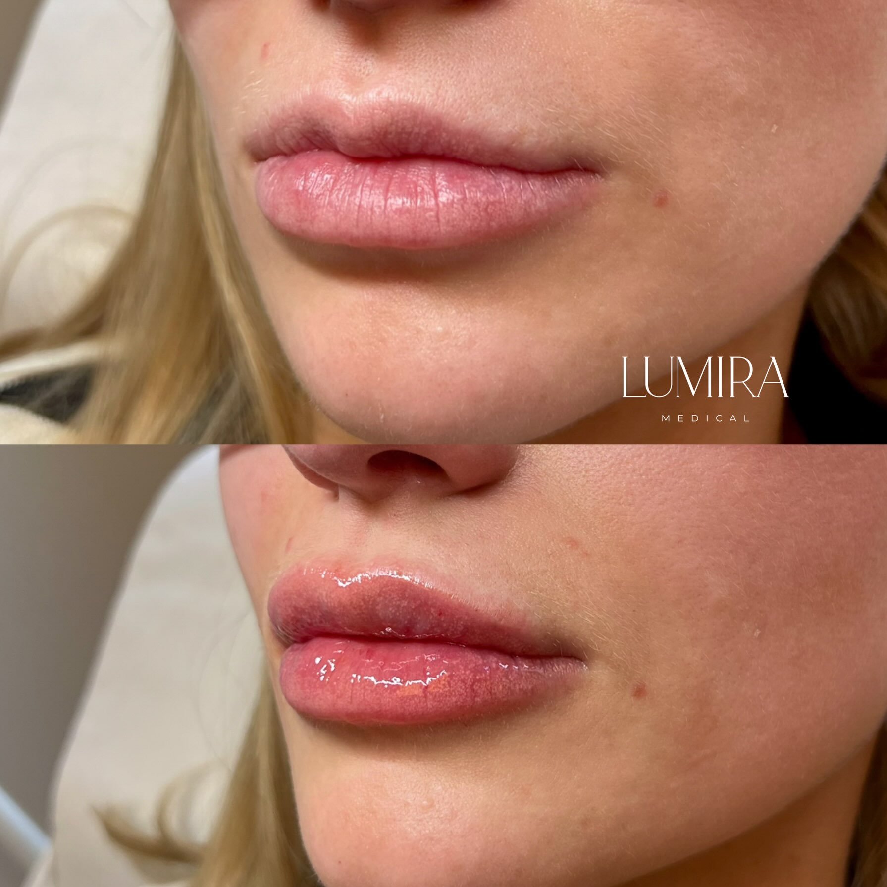 &ldquo;I&rsquo;ve never liked the shape of my top lip&rdquo; 

Not everyone comes to me wanting fuller lips. Sometimes it&rsquo;s about correcting an asymmetry or softening a feature that&rsquo;s always made someone feel self-conscious. 

For this pa